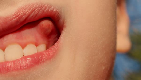เหงือกบวม (Swollen Gums) : อาการ สาเหตุและการรักษาของโรค