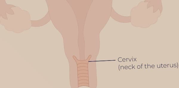 โรคมะเร็งปากมดลูก  (Cervical Cancer)