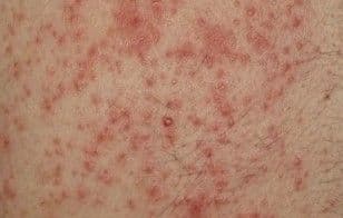 ผิวหนังอักเสบ (Dermatitis)
