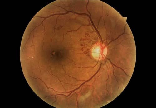 เบาหวานขึ้นจอประสาทตา (Diabetic retinopathy)