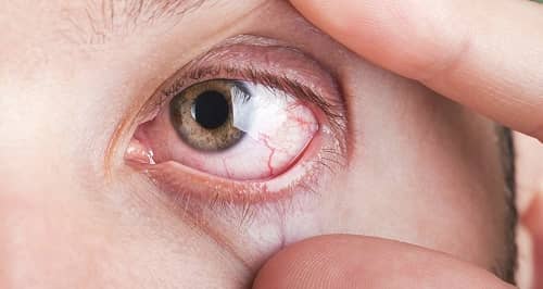ปวดตา (Eyepain)