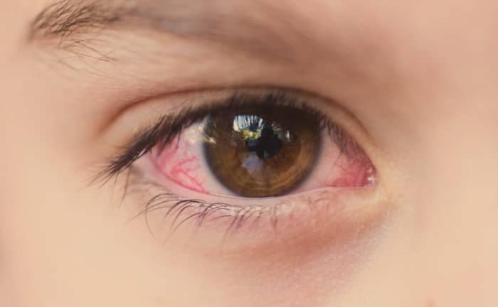 ภูมิแพ้ขึ้นตา (Allergic Conjunctivitis)
