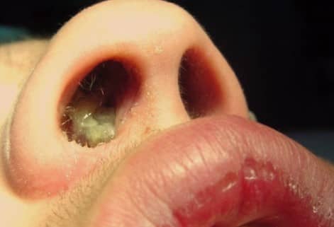 โรคริดสีดวงจมูก (Nasal Polyps)