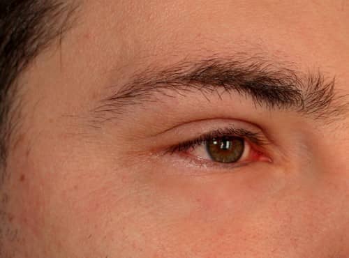 ตาบวม (Swollen Eyes) : อาการ การรักษา