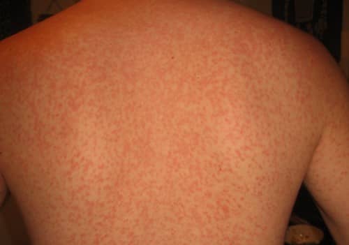 Fever rash (viral rashes)