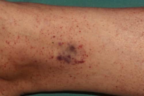เกล็ดเลือดต่ำ (Low Platelet count) : อาการ สาเหตุ การรักษา