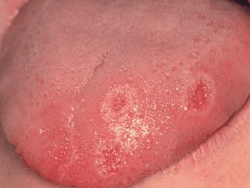 เจ็บลิ้น (Tongue Problems) : อาการ สาเหตุ การรักษา