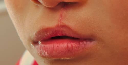 ปากแหว่งเพดานโหว่ (Cleft Palate and Lip) : อาการ สาเหตุ การรักษา