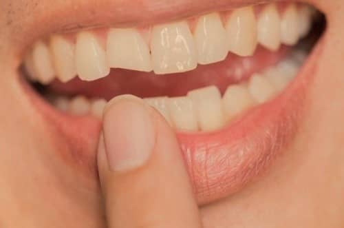 ฟันร้าว (Cracked Tooth) : สาเหตุ อาการและการรักษา