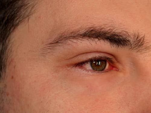 Eyelid Inflammation