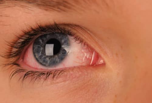 Light Allergy Eyes