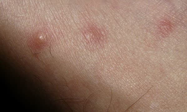 Insect Bites and Stings