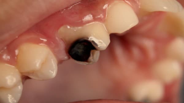 Tooth Cavities