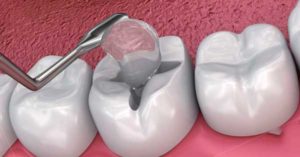 Facts About Dental Fillings