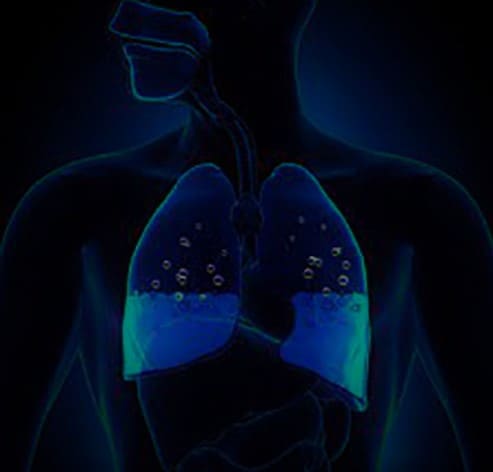 Pulmonary Edema