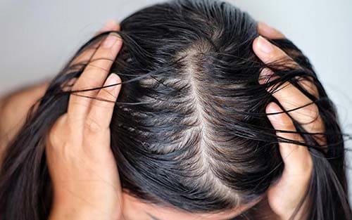 How can I treat my oily scalp