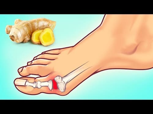 Natural Home Remedy for Gout