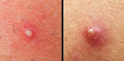 a boil or pimple 