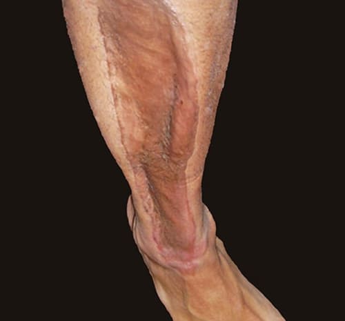 compartment syndrome 