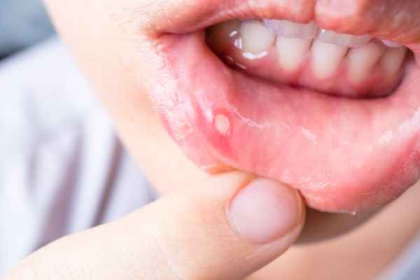 Tips to Avoid Mouth Ulcers