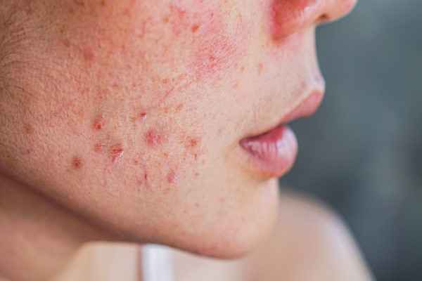 How to Deal with Inflamed Acne 
