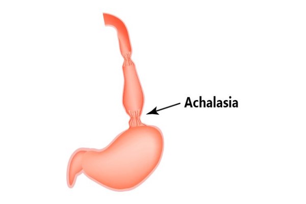 Achalasia 