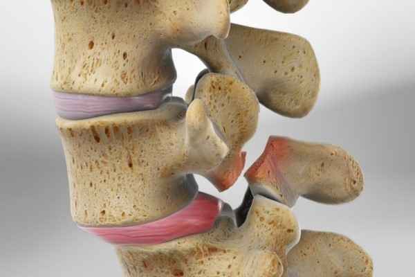 Spondylolisthesis