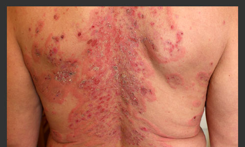 Stevens Johnson Syndrome