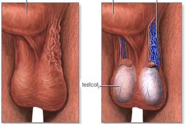 Varicocele