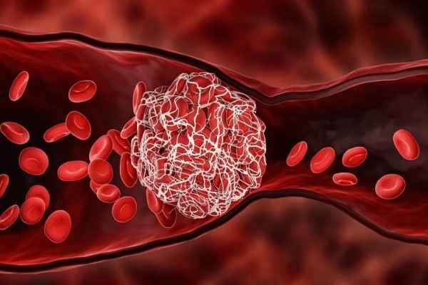 Venous Thromboembolism